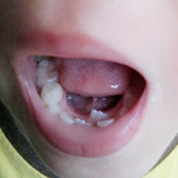“六龄齿”不是乳牙 坏了一定要治
