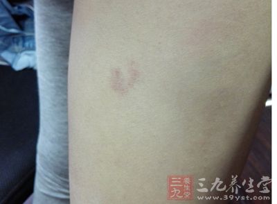 婴儿这里发红 或是大病前兆