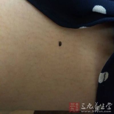 大腿的痣主财富,代表了荣华富贵