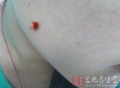 疥疮、恶疮、无名疮的治疗方法也非常简单