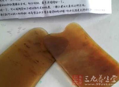 刮痧是中医中常见的一种治疗方法