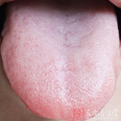 然而,白色或黄色舌苔(并伴有发痒或敏感)则可能是细菌或真菌感染.