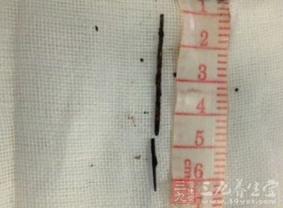 福建19岁<em>女孩</em>咳嗽不止 <em>胸腔取出</em>5厘米长<em>钢针</em> 