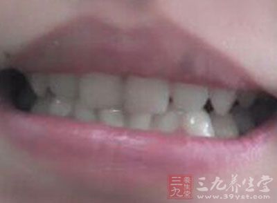 牙龈止血也止鼻血 牙龈止血也止鼻血