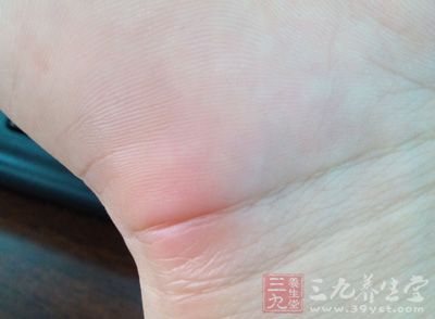 腱鞘炎症状 手指腱鞘炎症状