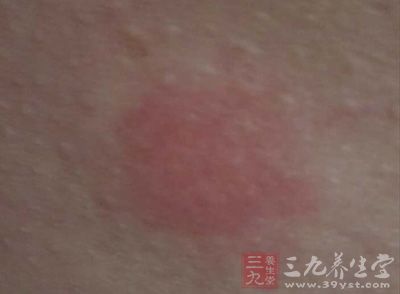 皮肤过敏也可能引起背上长痘痘