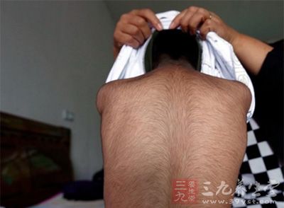 安徽6岁 男童 患怪病 体重30斤全身 长满黑毛  - 三
