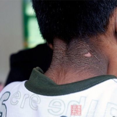 安徽6岁 男童 患怪病 体重30斤全身 长满黑毛  - 三