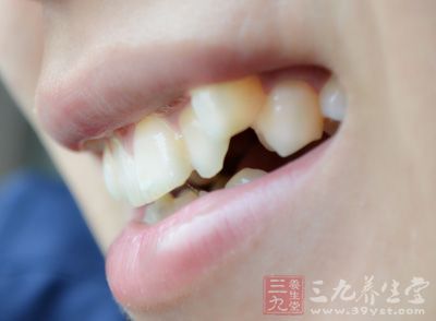 多发生于成人个别牙齿牙龈缘及乳头轻度坏死