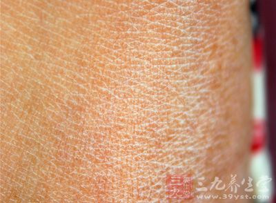 局限性无汗症引起的皮肤干燥粗糙可搽一些无