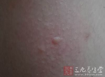 濕疹性皮炎 如何預(yù)防濕疹性皮炎