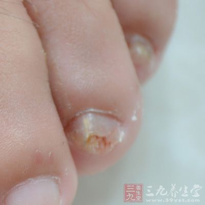 长期的脚气将可能导致灰指甲甚至是丹毒等其他疾病