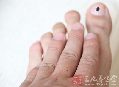 太婆趾甲盖长黑斑拖了一年要锯腿