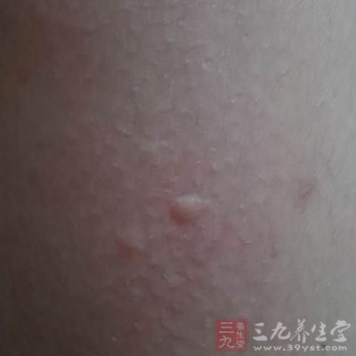 为了防止粉刺的发生