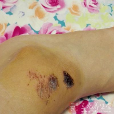 脚部扭伤 脚部扭伤