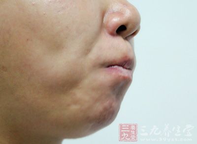 干净大蒜，生吃，每日两至三瓣