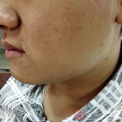 脸部过敏怎么办 男人皮肤也需细心呵护(4)