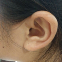 慢性化脓性中耳炎