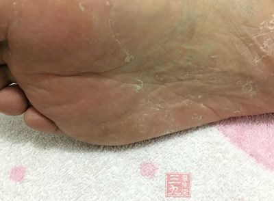 足癣俗称脚气、香港脚，是由真菌引起的传染性脚部皮肤病，容易反复发作