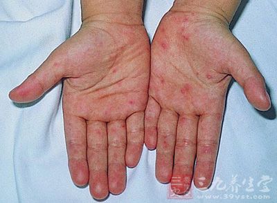 女子体检时尿酸升高 专家称非痛风诊断标准 女子体检时尿酸升高 专家称非痛风诊断标准