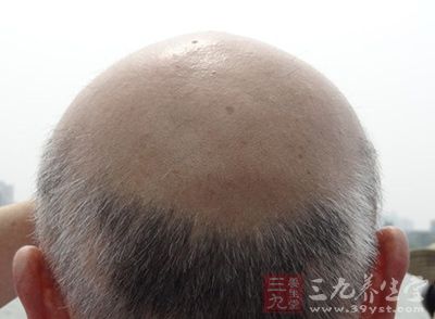 防男人脫發(fā)必試六個(gè)妙招