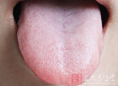 舌乳头萎缩后,成为鲜红或暗红色平滑斑,可发生糜烂
