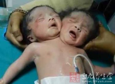  孟加拉再现双头婴  此前案例两天后夭折 - 三九
