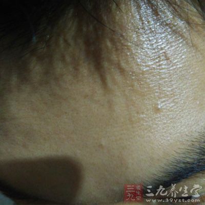 辟谣3:长痘痘是因为有螨虫? 辟谣3:长痘痘是因为有螨虫?