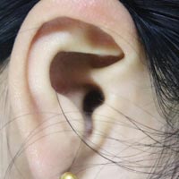 治疗中耳炎的偏方 中耳炎应该吃什么