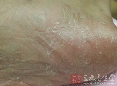 腳氣是個頑固性疾病，得了腳氣非常難受