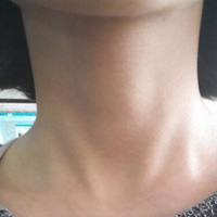 萎缩性咽炎的疾病查询