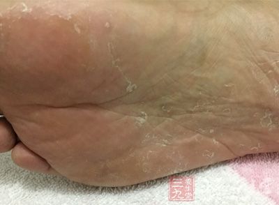 足癣俗称脚气、香港脚,是由真菌引起的传染性脚部皮肤病,容易反复发作 足癣俗称脚气、香港脚,是由真菌引起的传染性脚部皮肤病,容易反复发作