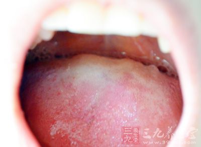 口腔黏膜白斑的表现