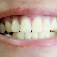 治疗虫牙的民间偏方 有效治疗虫牙