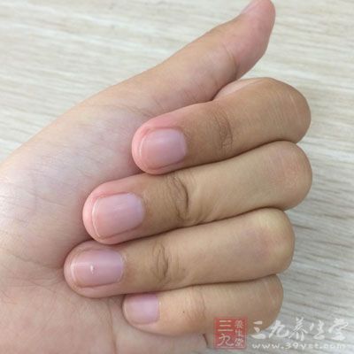 如果指甲生长缓慢,没有光泽并且变黄变厚,提示淋巴系统出了毛病 如果指甲生长缓慢,没有光泽并且变黄变厚,提示淋巴系统出了毛病