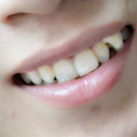 牙龈癌的疾病查询