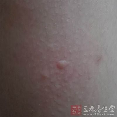 每逢月经来潮前2-3天皮肤瘙痒,出现疱疹、红斑或发生紫癜等。 每逢月经来潮前2-3天皮肤瘙痒,出现疱疹、红斑或发生紫癜等。