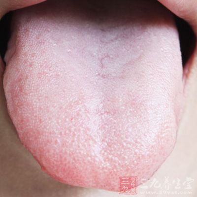 舌苔是人体内毒素积聚的主要表现形式