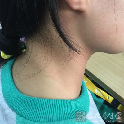 疤痕较大者常见于颈前侧