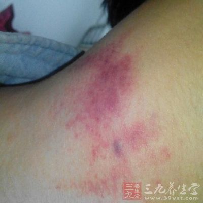 拔火罐时间别超10分钟 拔火罐时间别超10分钟