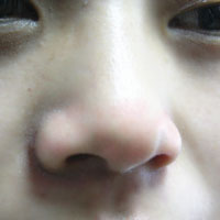 民间治疗鼻炎的偏方 鼻炎的危害有哪些