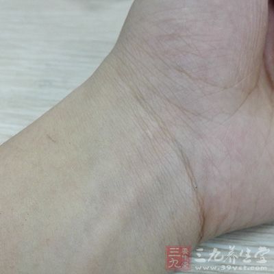 风湿性关节炎常见累及腕关节