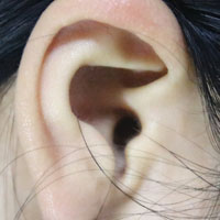 耳鸣耳聋二者的中医辨证论治基本相同