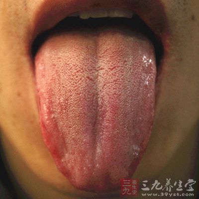 舌红苔白，脉浮数等属于风热目疾