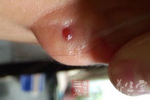 就是哪里有病哪里就有穴位 就是哪里有病哪里就有穴位