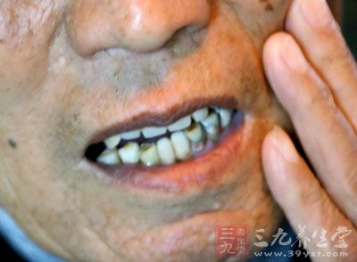 龋齿及龋病俗称虫牙、蛀牙，是细菌性疾病