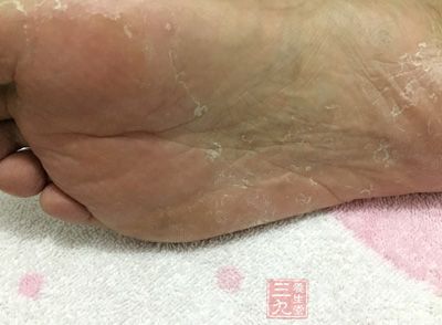 足癣是由致病性真菌引起的足部皮肤病