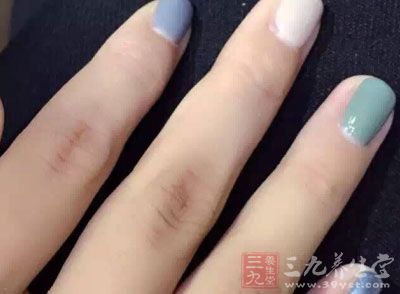 灰指甲元凶就在身边