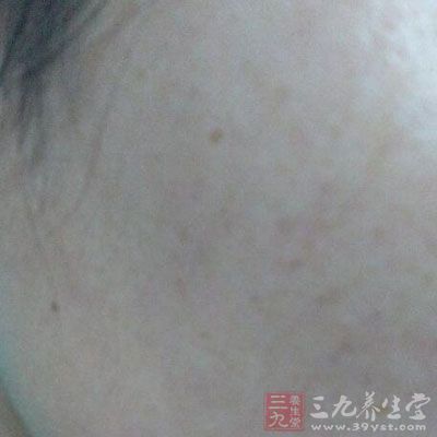 行动四:不急不躁祛斑 行动四:不急不躁祛斑