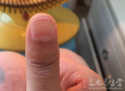 指甲表面有凸起的棱线 指甲表面有凸起的棱线